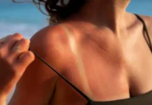 Callo solar: ¿en qué consiste esta tendencia y cuáles son los riesgos?