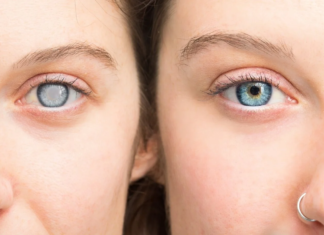 Glaucoma: La enfermedad silenciosa que roba la vista